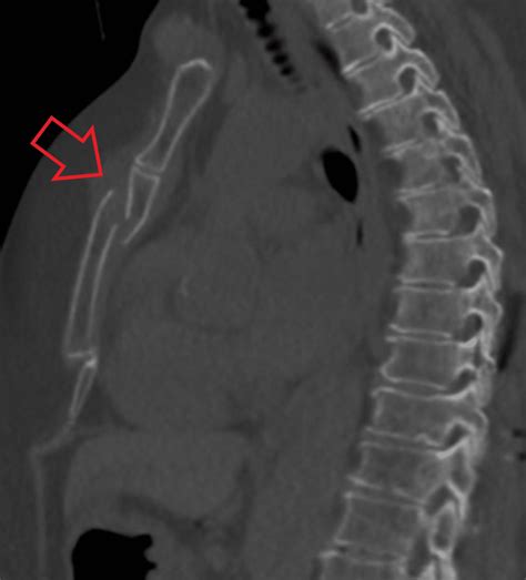 barrel compression test sternal fracture|sternal fracture death rate.